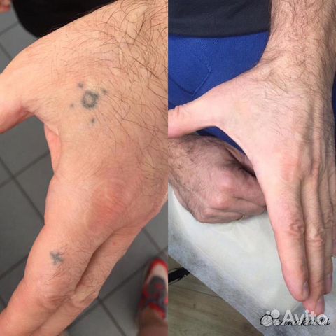 Удаление татуировок и татуажа